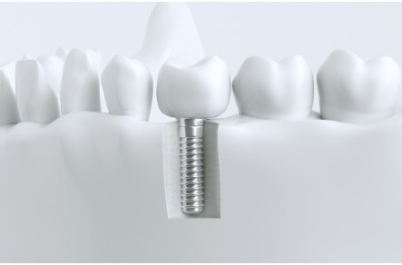 种植牙4大误区 重庆牙科医院