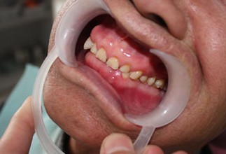 牙体磨耗怎么办? 重庆牙科医院