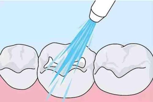 窝沟封闭,保护孩子牙齿 重庆牙科医院